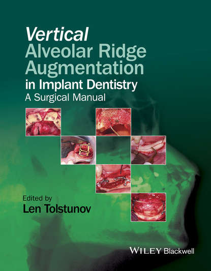 Vertical Alveolar Ridge Augmentation in Implant Dentistry - Группа авторов