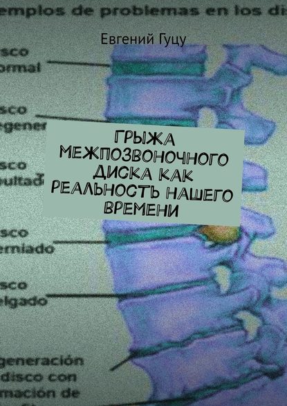 Грыжа межпозвоночного диска как реальность нашего времени - Евгений Валерьевич Гуцу