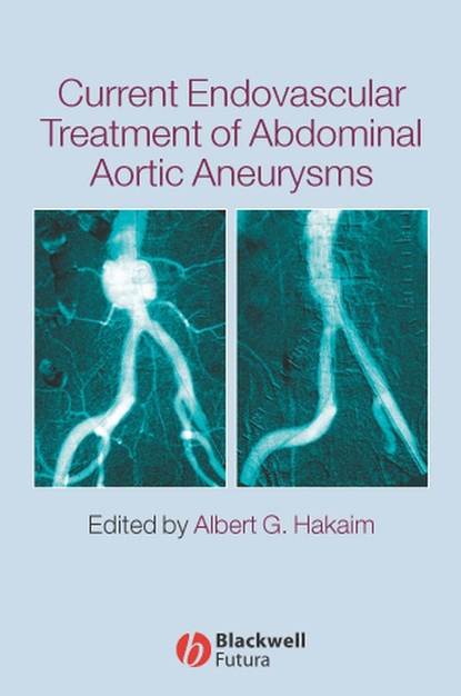 Current Endovascular Treatment of Abdominal Aortic Aneurysms - Группа авторов