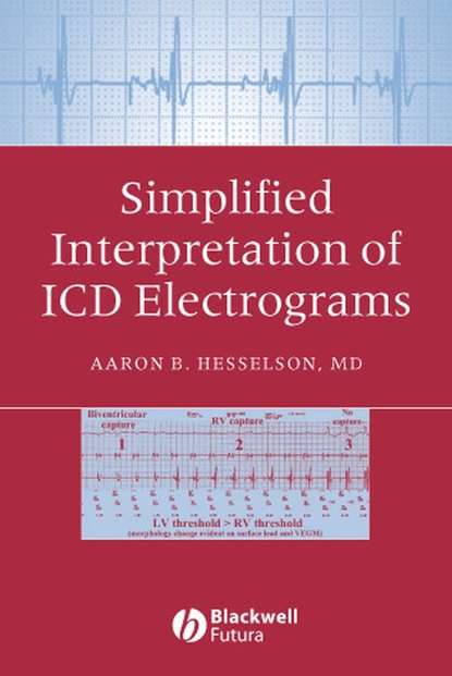 Simplified Interpretation of ICD Electrograms - Группа авторов