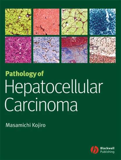 Pathology of Hepatocellular Carcinoma — Группа авторов